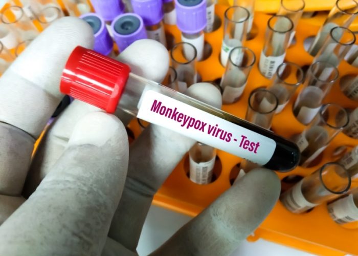 Maymun çiçeği virüsünde bu belirtilere dikkat!