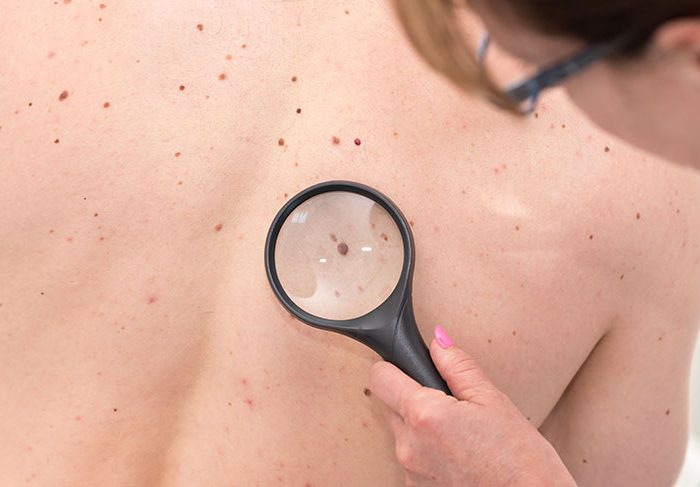 Yapay zeka ile cilt kanserine önlem