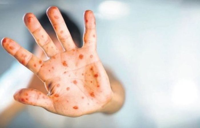 Maymun Çiçeği Virüsü hakkında bilinmeyenler