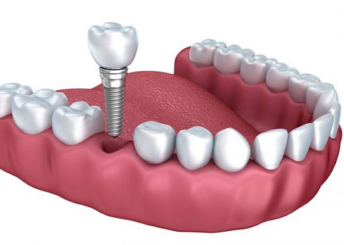Dişlere implant yaptırırken şunlara dikkat edin