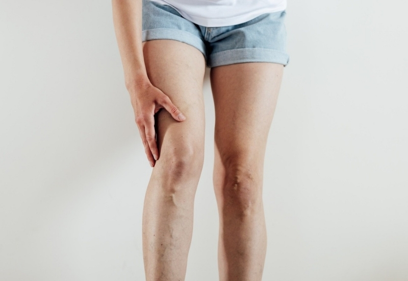 Varis ve Lipödemi Tetikleyen 8 Hata